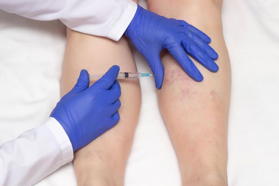 Scleroterapia este o metodă de tratare a venelor varicoase