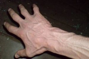 metode de tratare a varicelor în mâini