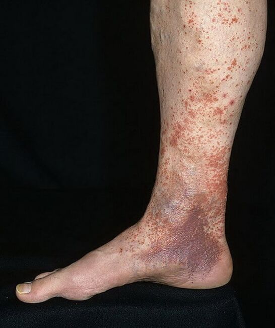 Dermatită varicoasă