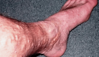 cauzele varicelor la picioare la bărbați