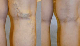 semne și simptome ale varicelor pe picioare la bărbați