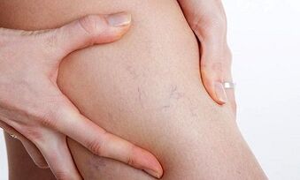 motive pentru dezvoltarea venelor varicoase la nivelul picioarelor