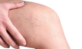 stadiile dezvoltării venelor varicoase