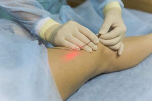 Varice: Cum ajuta tratamentul cu laser endovenos in cazul venelor inestetice