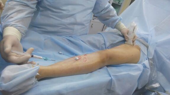 chirurgie pentru varice la nivelul picioarelor