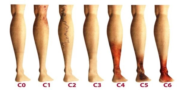 Ce exerciții pot fi și nu se pot face cu varice ale picioarelor - Tromboflebita - August