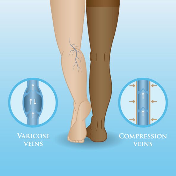 Efectele îmbrăcămintei de compresie asupra varicelor din picioare