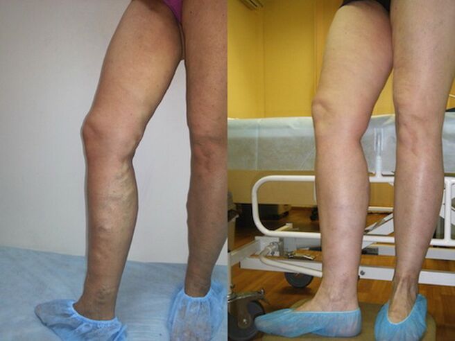 Picioare înainte și după tratamentul cu laser al varicelor
