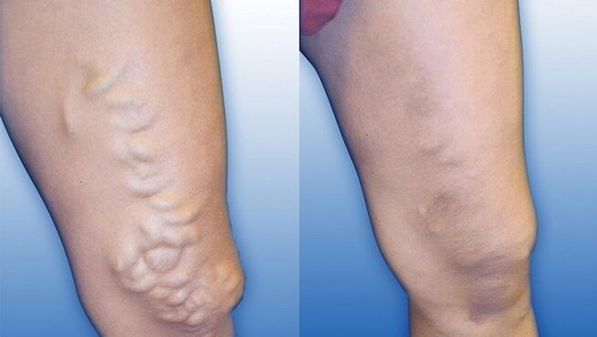 Picioare înainte și după tratamentul varicelor severe