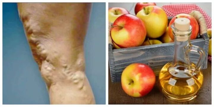 cum să tratezi venele varicoase cu oțet de mere
